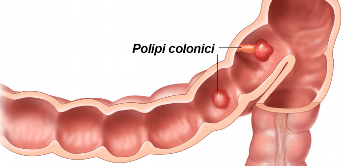 Ce sunt polipii pe colon?