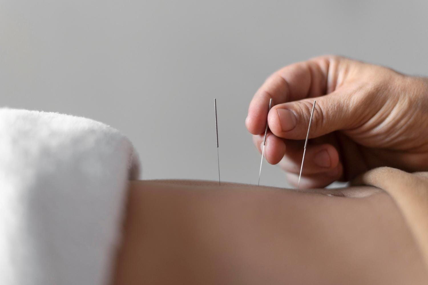 Când este indicat tratamentul cu ace de acupunctură?