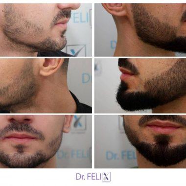 Implant de barbă preț- Ce influențează costul? Dr. Felix Hair Implant